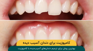 بهترین روش برای ترمیم دندانهای آسیبدیده با کامپوزیت
